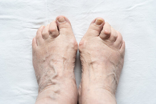 Top view of female feet together with hammer toes, broken nails and dry skin over white background. Hygiene, medical, health care, podiatrist, dermatology concepts