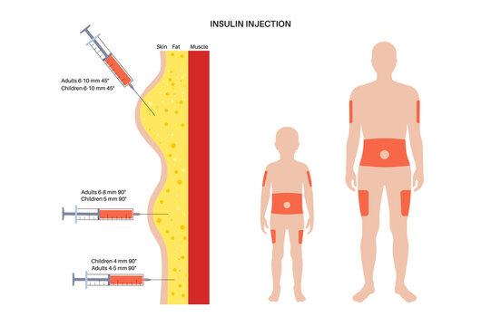 Insulin injection sites