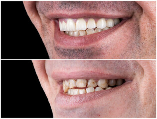 Obraz premium press ceramic crowns and veneers natural color
