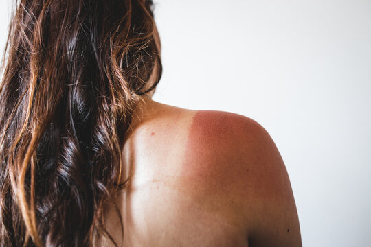 Sun Exposure And Sunscreen Use, Girl Revealing Intense Tan Lines On Her Shoulder