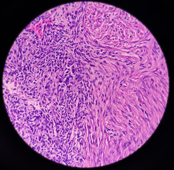 Uterus wall: Simple endometrial hyperplasia, show revealing features of simple endometrial hyperplasia, no malignant cells present.