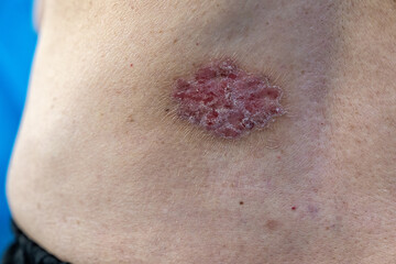 Image of patient with Psoriasis. Psoriasis is a chronic, inflammatory autoinmune skin disease