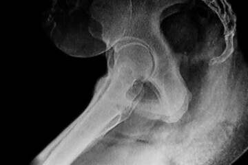 X- ray image of a pelvimetry. Medical themes