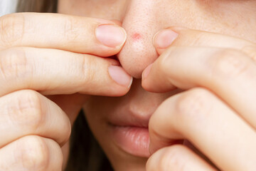 Cropped shot of a young woman squeezing out a red inflamed pimple with her hands isolated on a white background. Acne problem, comedones. Cosmetology dermatology concept