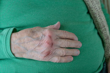 closeup wrinkled and dried hand with wound or burn scar of old person