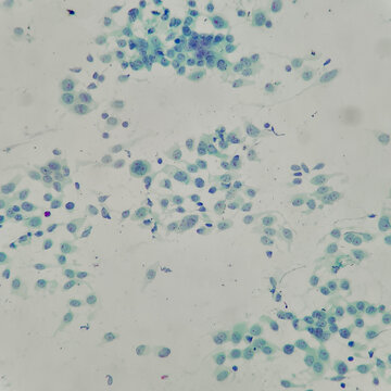 Camera photo of specimen from fine neddle aspiration, showing ductal carcinoma, magnification 400x, photograph through a microscope