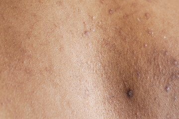 Fototapeta premium close up of young man suffering skin problem .