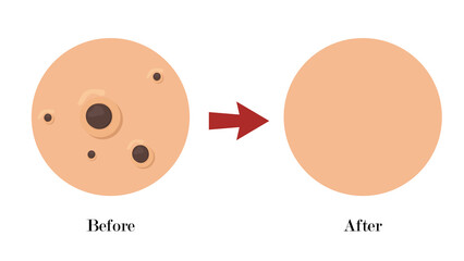 close up skin, blackhead pimples acne type face pore.skincare problems concept.befire after