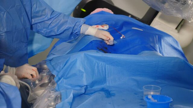 Vascular surgery. Radiologist performs endovascular operation with angiography machine. Doctor using contrast liquid for uterine fibroid embolization. Cardio-vascular examination. 4k video