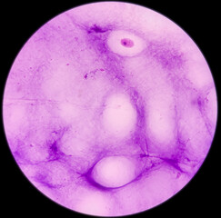 Wrist joint(FNA): Ganglion cells, show , microscopic view foamy histiocytes, lymphocytes and background of proteinaceous material. 40x view