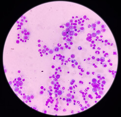 Microscopic view of bone marrow slide, megaloblastic anemia, mylodysplastic anemia, hyperactive and...