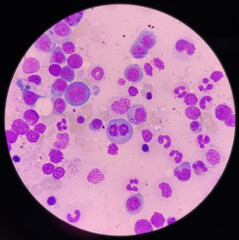Microscopic view of bone marrow slide, megaloblastic anemia, mylodysplastic anemia, hyperactive and...