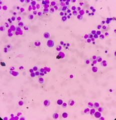 Microscopic view of bone marrow slide, megaloblastic anemia, mylodysplastic anemia, hyperactive and...