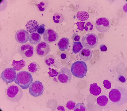 Microscopic view of bone marrow slide, megaloblastic anemia, mylodysplastic anemia, hyperactive and show normoblastic, early megaloblastic maturation, MDS disease
