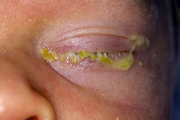 eye infection conjunctivitis in a newborn baby