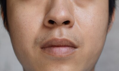 Oily face of Asian, Myanmar or Korean young man.