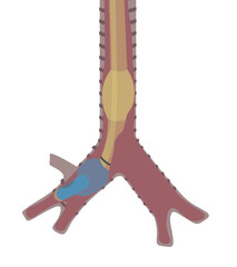 Independent lung ventilation illustration of a right doble lumen   tube positioned. Tube position for Thoracic surgeries