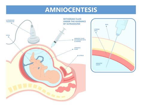 Amniocentesis diagnostic test treat LAB analysis DNA gene screen risk detect neural tube exam villus CVS check baby cell birth fetal sex down afp tay sachs spina alpha fetus loss cystic second fluid