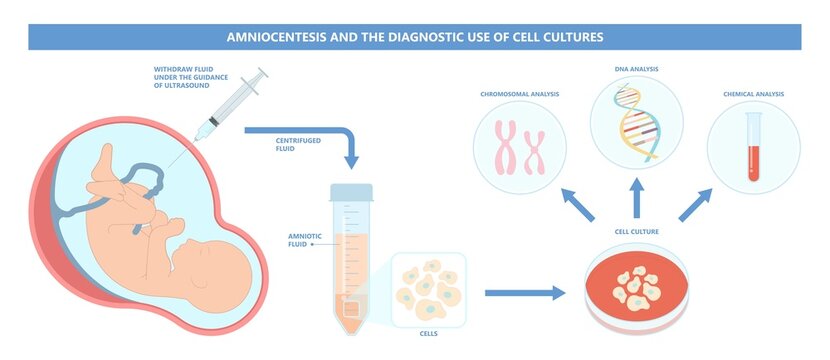 Amniocentesis diagnostic test treat LAB analysis DNA gene screen risk detect neural tube exam villus CVS check baby cell birth fetal sex down afp tay sachs spina alpha fetus loss cystic second fluid