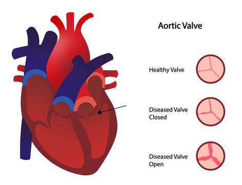 Aortic valve stenosis illustration. Healthy and disease aortica valve