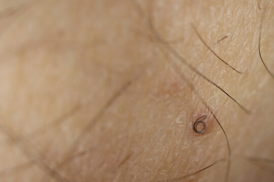 twisted ingrown hair on a white caucasian skin - shallow depth of field close-up