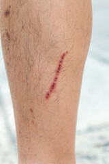  scar on skin. The wound form scabs on leg. Man with long scab wound on right leg.	
