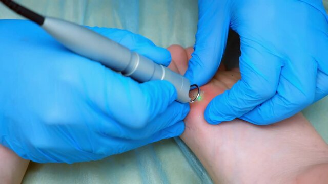 Surgeon is removing wart on teen boy's foot using laser in hospital, hands in gloves closeup. Remove papillomavirus verruca on leg. One day surgery concept. Sore and wound after operation.