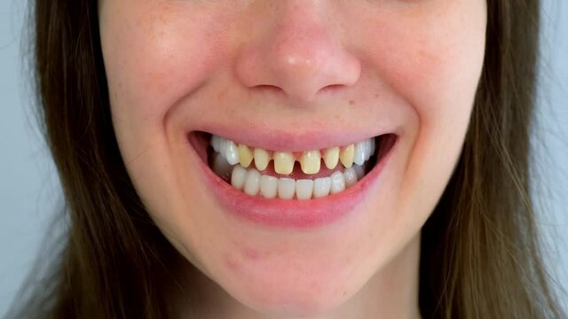 Smiling mouth of woman with yellow bad teeth prosthetics of teeth concept. Teeth sharpened by a dentist before installing crowns and ceramic veneers. Dentistry treatment, prosthetics of teeth concept.