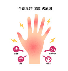 手荒れ (手湿疹) の原因 ベクターイラスト