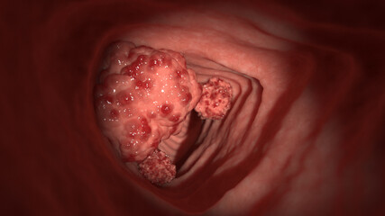 3d rendered illustration of colon tumors