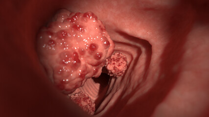 3d rendered illustration of colon tumors