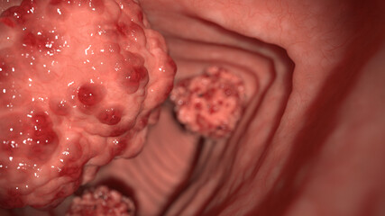 Fototapeta 3d rendered illustration of colon tumors obraz
