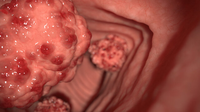 3d rendered illustration of colon tumors