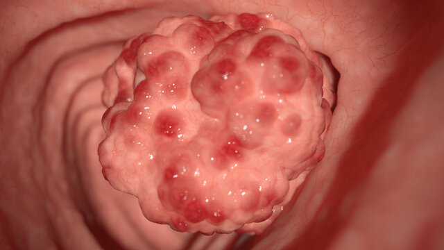 3d rendered illustration of colon tumors