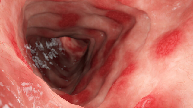 3d rendered illustration of colitis ulcerosa