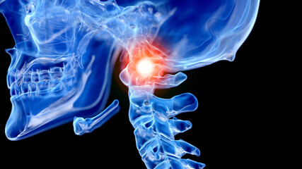 3d rendered illustration of a painful atlas vertebrae