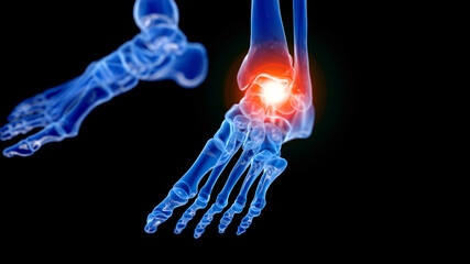 3d rendered illustration of a painful ankle