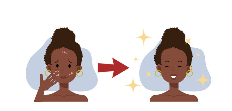 treat acne,skin problem,pimple .african american woman face.Beautyful. Flat vector 2d cartoon character illustration. Before, after