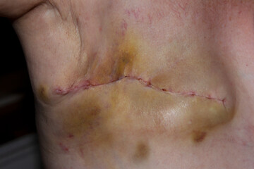 Fresh scarring after mastectomy surgery for breast cancer. - obrazy, fototapety, plakaty