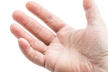 image of the mens hand showing skin disease isolated on white background