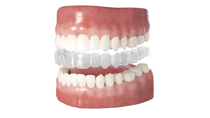3d rendered illustration of a clear dental aligner