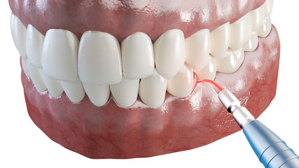 3d rendered illustration of a dental gum correction