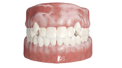 3d rendered illustration of impacted incisors