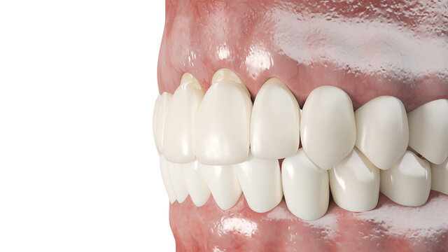 3d Rendered Illustration Of A Dental Gum Recession