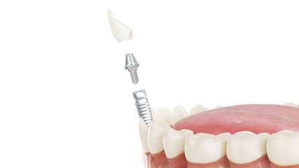 3d rendered illustration of a dental implant