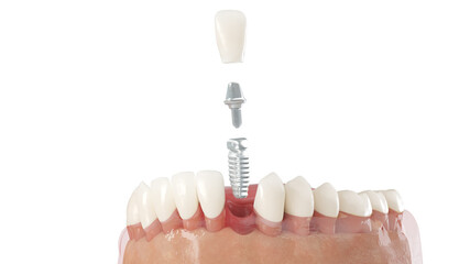 3d rendered illustration of a dental implant