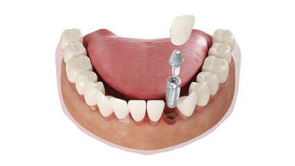 3d rendered illustration of a dental implant