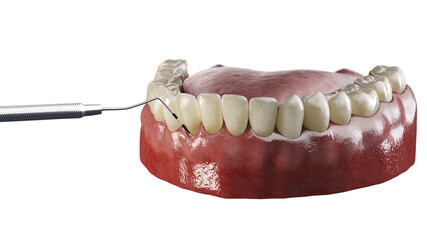 3d rendered illustration of periodontitis testing