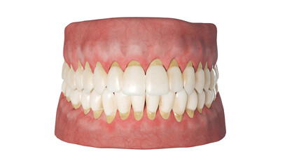 3d rendered illustration of periodontitis