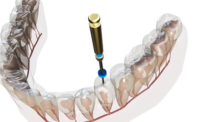 3d rendered illustration of a root canal treatment